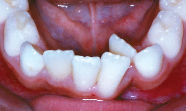 Crowding JH Family Orthodontics in Dyer, IN