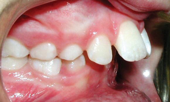 Protrusion JH Family Orthodontics in Dyer, IN