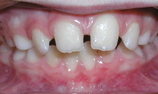 Spacing JH Family Orthodontics in Dyer, IN