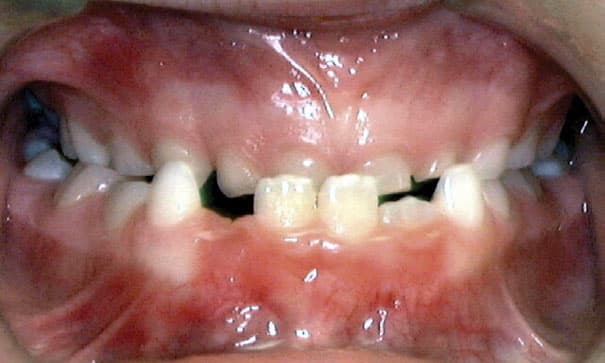 Underbite JH Family Orthodontics in Dyer, IN